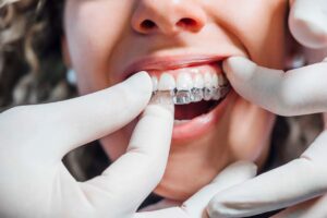 Dentist fitting a clear plastic aligner made with Phast's sustainable PHA bioplastics